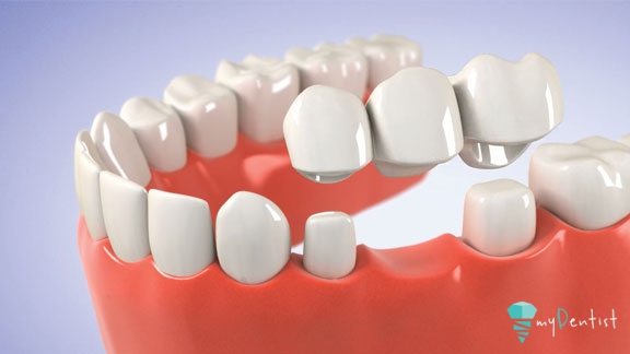 Dental bridges – Dentures