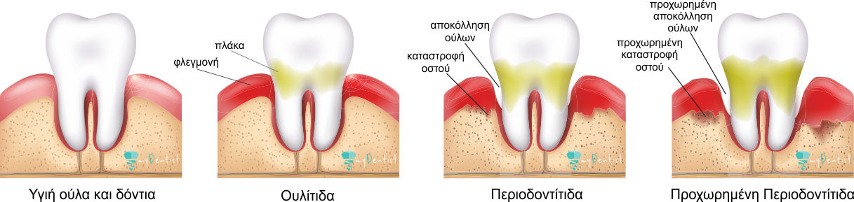 Περιοδοντίτιδα