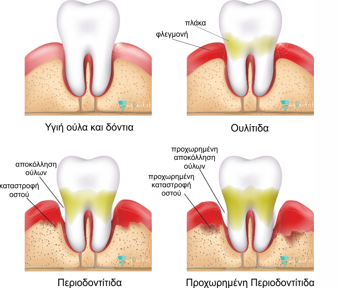 Περιοδοντίτιδα