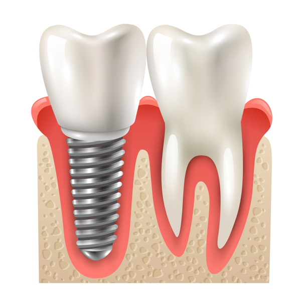 Dental Implant