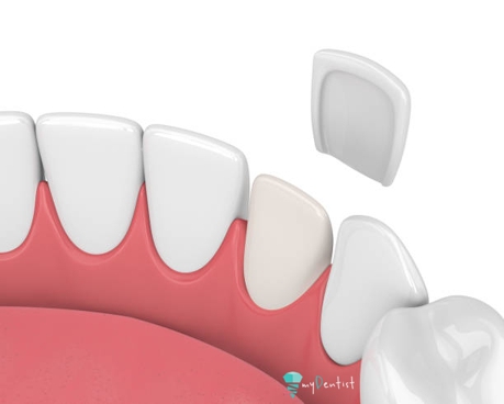 porcelain veneers