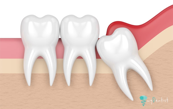 wisdom teeth