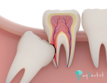 wisdom teeth damages the next tooth